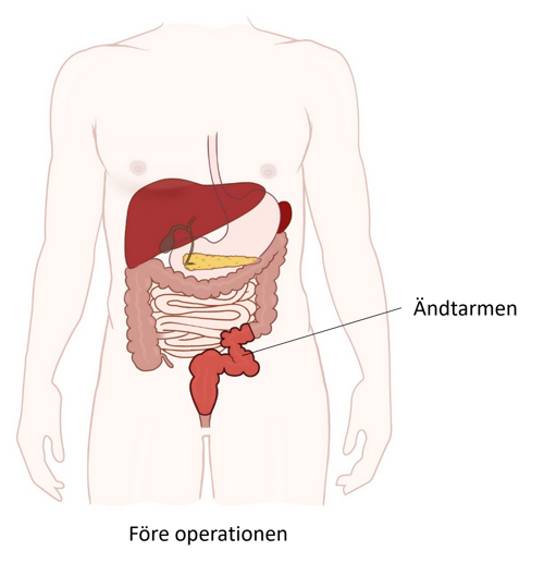 Illustration av buken före operationen.