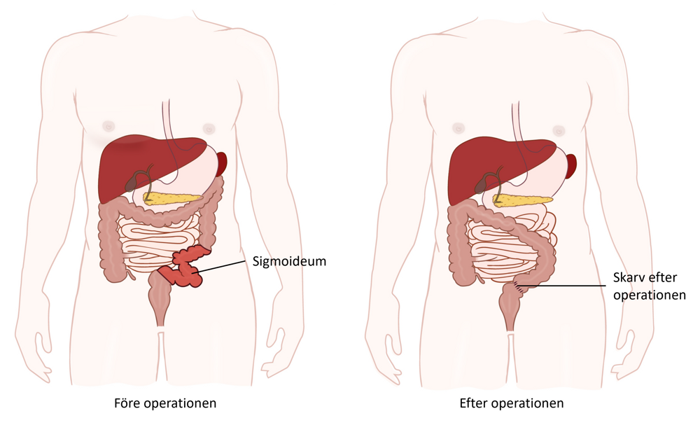 Illustration med buken före och efter operation. Bilden till vänster visar nedre vänstra delen av tjocktarmen, som kallas kolon sigmoideum. Bilden till höger visar den skarvade tarmen när sigmoideum har opererats bort.