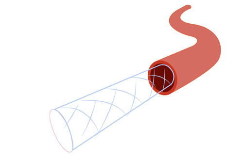 Illustration av ett stent.
