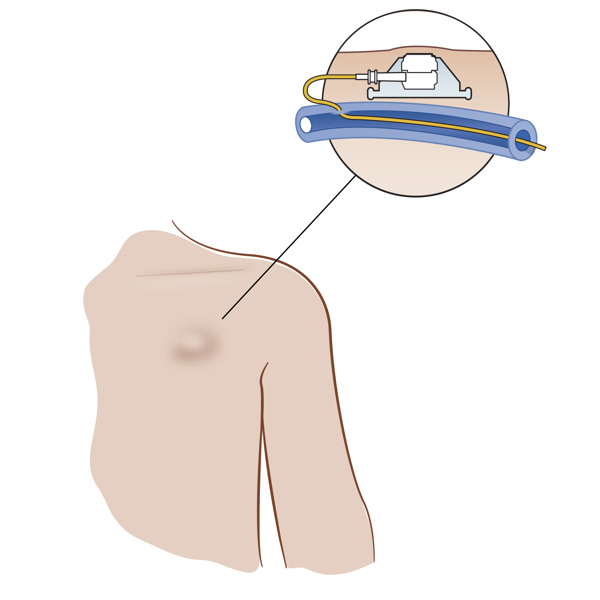 En illustration visar slangen som är fäst under venporten och som sedan fortsätter i ett blodkärl