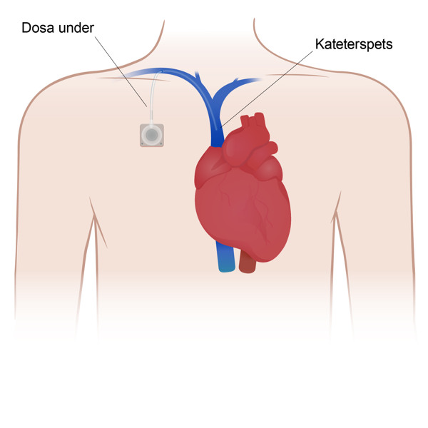 Bilden visar venporten, blodkärlet med kateterspetsen som är fäst nära hjärtat.