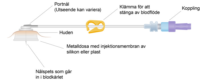 Bilden visar metalldosan från sidan som sitter utanför, sedan huden, där efter spetsen ner i blodkärlet. Ovanför metalldosan ligger en lång smal portnål horisontellt åt höger mitt på den en klämma och sist en koppling för slangen.