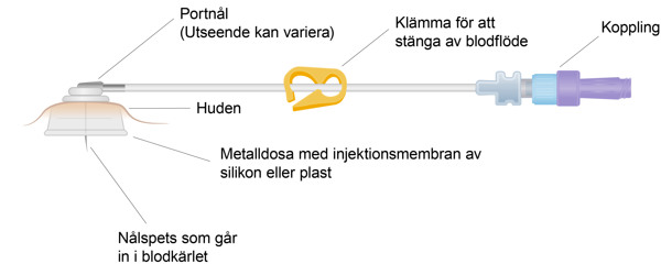 En översikt över delarna i en medicinteknisk produkt. Metalldosa, portnål, kateter och koppling. 