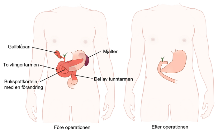 Illustration före och efter total pankreatektomi.