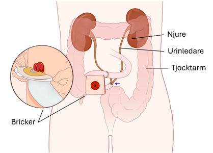 En schematisk bild över njurarna, urinvägarna och tarmarna i kroppen, samt en stomipåse som fästs på magen där stomin sitter.
