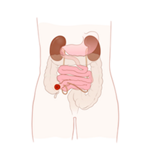 Tvärsnitt av buken med urostomin placerad på den högra sidan av magen.