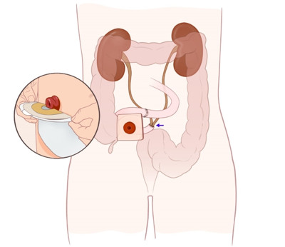 Bilden visar magen i genomskärning där urinen leds genom en stomi och samlas i en urostomi på magen.