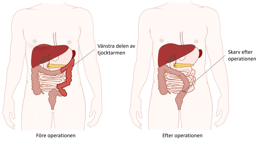 Illustration av buken före och efter operationen.