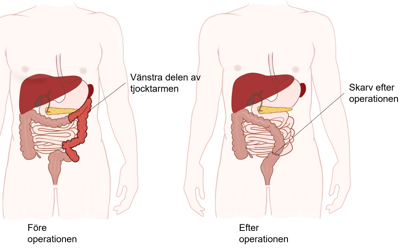 Illustration av då den vänstra delen av tjocktarmen tagits bort