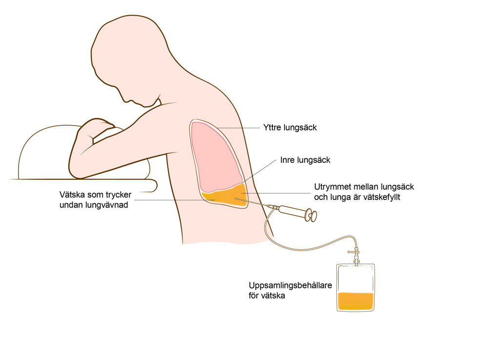 En person sitter framåtlutad, en lunga syns från sidan och uppsamlingsbehållaren samlar vätska via en spruta som är instucken i lungan från ryggen.
