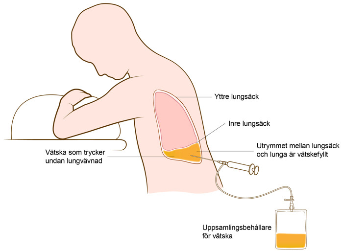 Tecknad person som sitter lite framåtlutad. Spruta kopplad till en uppsamlingspåse, sticks in i lungan ifrån ryggsida.