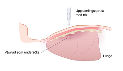 Vävnad i lunga undersöks med uppsamlingsspruta med nål