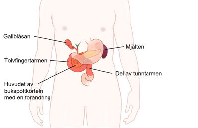 Före en pankreatoduodenektomi