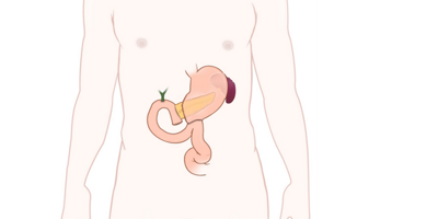 Efter en pankreatoduodenektomi med Whipple
