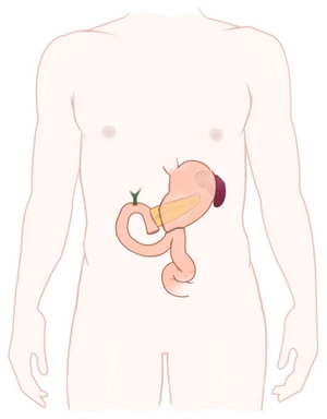 Tvärsnitt efter operation med Whipple.