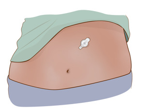 Illustration av mage med gastroknapp.