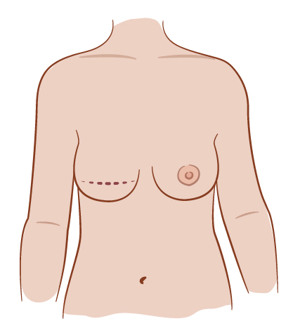 Illustration av bröst med horisontellt ärr.