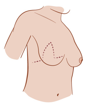 Illustration av ärr på bröstet och sidan vid killambå.