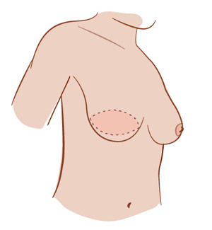 Illustration av ärr vid latissimus dorsi-lambå.