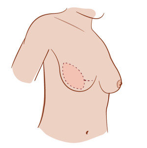 Illustration av ärr vid latissimus dorsi-lambå.