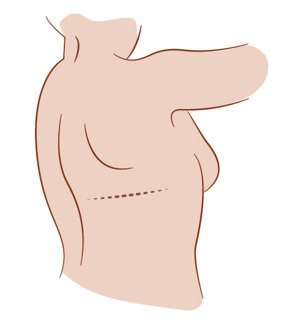 Illustration av ärr vid latissimus dorsi-lambå.