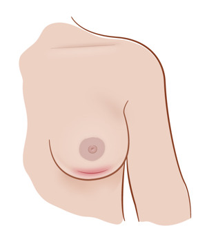 Illustration av bröst med rodnad kring såret.
