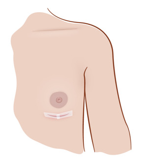 Illustration av bröst med tejpat sår.